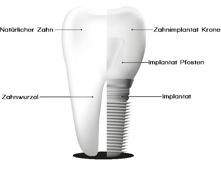 Zahnimplantat mit Zahnkrone